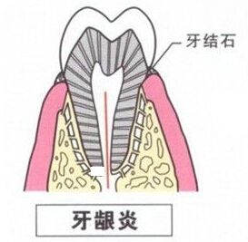 妊娠期牙龈炎