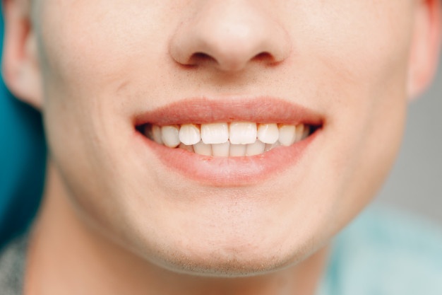 牙贴面能够维持多久-5年后拆掉贴面裡面牙齿会不会烂