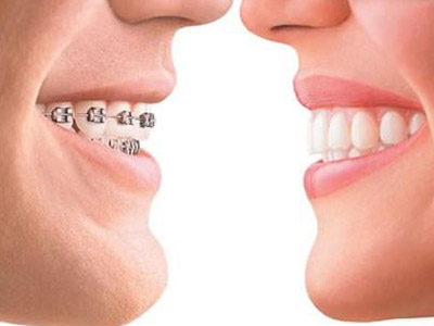 矫正牙齿有哪些风险？