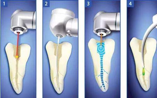 超声根管的治疗方法如何？