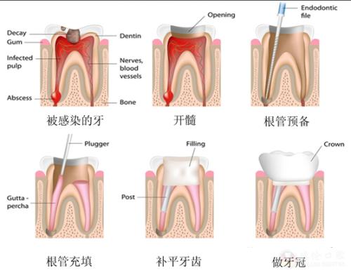 牙根暴露的原因及治疗办法？