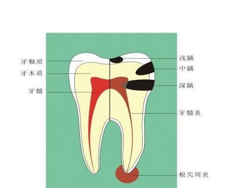 牙折的特点有哪些？