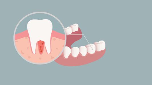 牙脱位后还应做什么治疗？