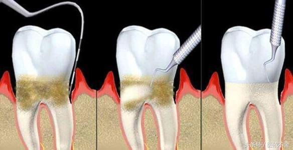 补牙三种常用材料的优缺点对比
