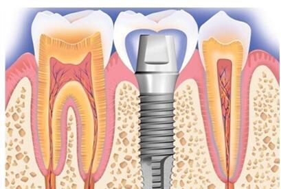 中医有哪些防治牙龈炎的方法和措施