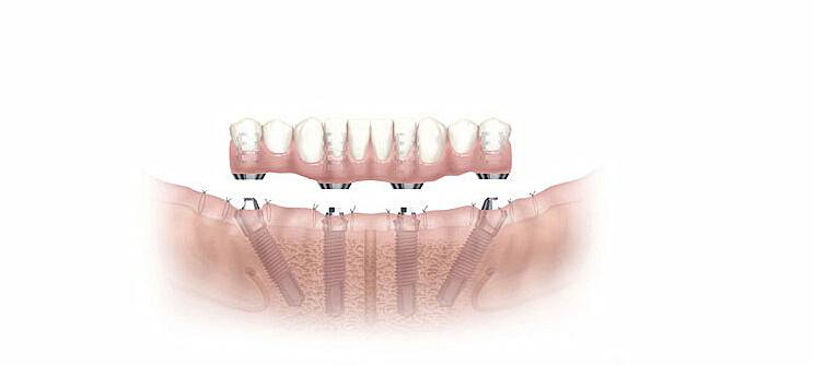 哪些人群不适合种植牙修复？