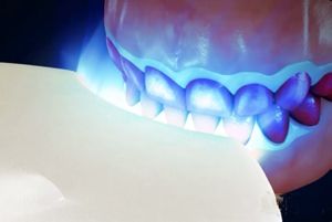 补牙可以引起口腔黏膜病