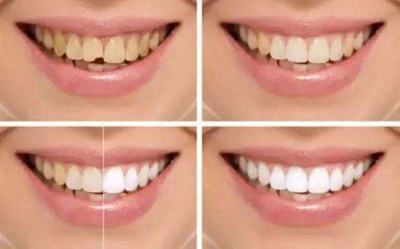 乳牙龋齿的特点有哪些？
