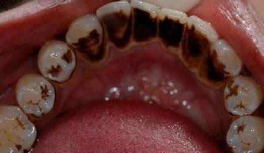 如何预防孩子出现双排牙