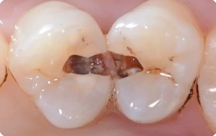 什么样的牙齿易患龋齿？