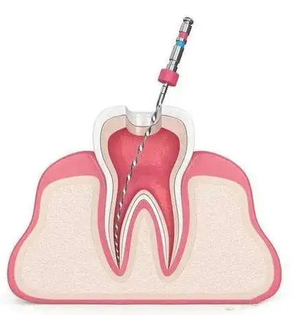 补牙的材料的优缺点