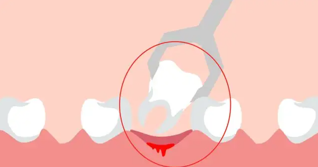 拔牙后的并发症和处理方法