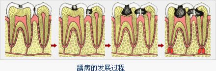 睡前不刷牙，危害特别大！_1