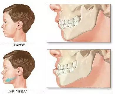 兒童牙齒矯正最佳時間家長別忽視，免得變成“地包天”！