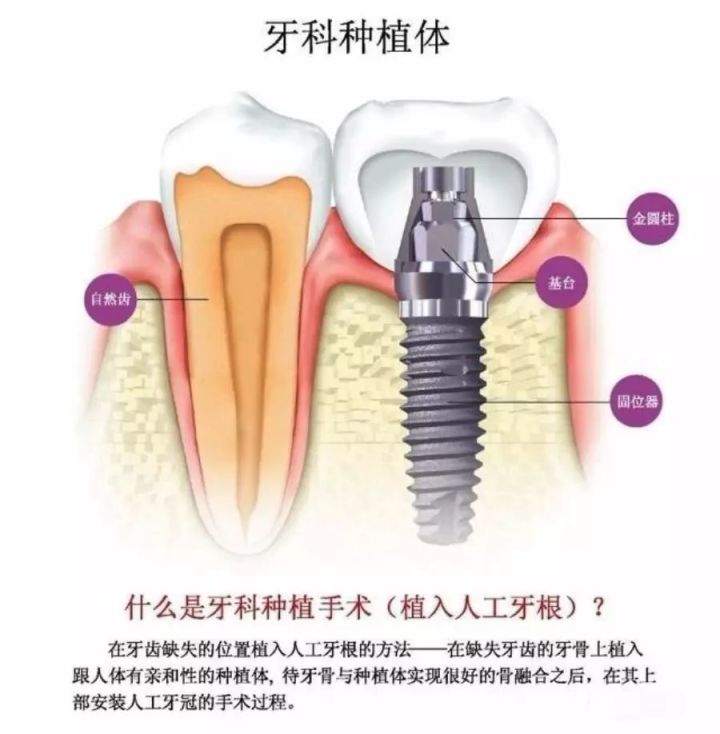 種植牙同拔牙對比解讀：種一枚牙齒，你要承受多少“傷害”？