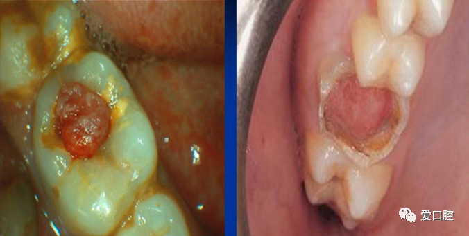 牙髓息肉嘅治療方法