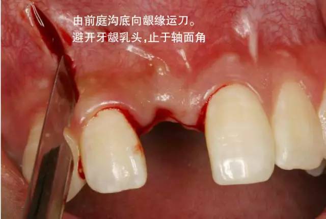 【牙医学堂】组织切口与瓣的设计、翻瓣术切开步骤--口腔种植手术学图解