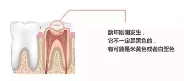 同样是补牙价格为什么差很远？