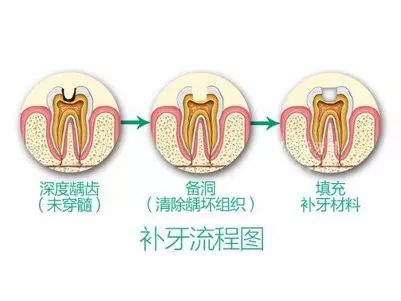 补牙没有那么容易每颗牙齿都有它的脾气