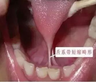 “剪舌筋”——该不该让孩子挨这一刀？