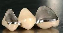 烤瓷牙和全瓷牙有什么区别？你选错了吗？