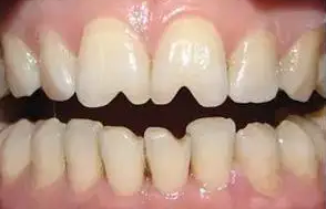 “瓜子牙”是嗑瓜子磕的吗？如何修復？