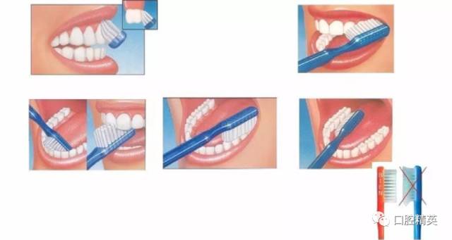 六一专题小孩子需要洗牙吗？洗完牙会使牙缝变大吗？洗牙可以使牙齿美白吗？