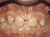 8张图带你见“正”牙齿畸形