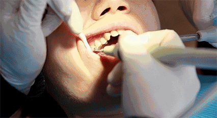 【种植牙】为什麼有些人种植手术前需要加骨粉骨膜？