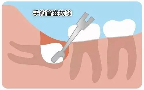 小伙智齿反复发炎脸部“烂穿”需要切开引流不拔智齿造成毁容太扎心