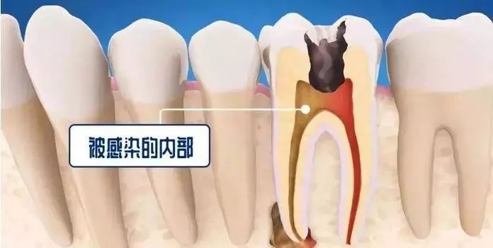 牙洞不补反而根管治疗？