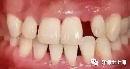 洗牙和牙周刮治有多大的区别