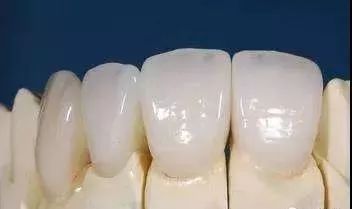 镶个全瓷牙能用多久？有什麼优势？