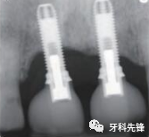 你认识种植体周围炎吗？