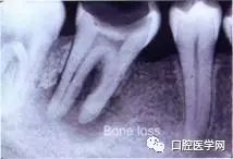 一步步看清根管治疗全过程！
