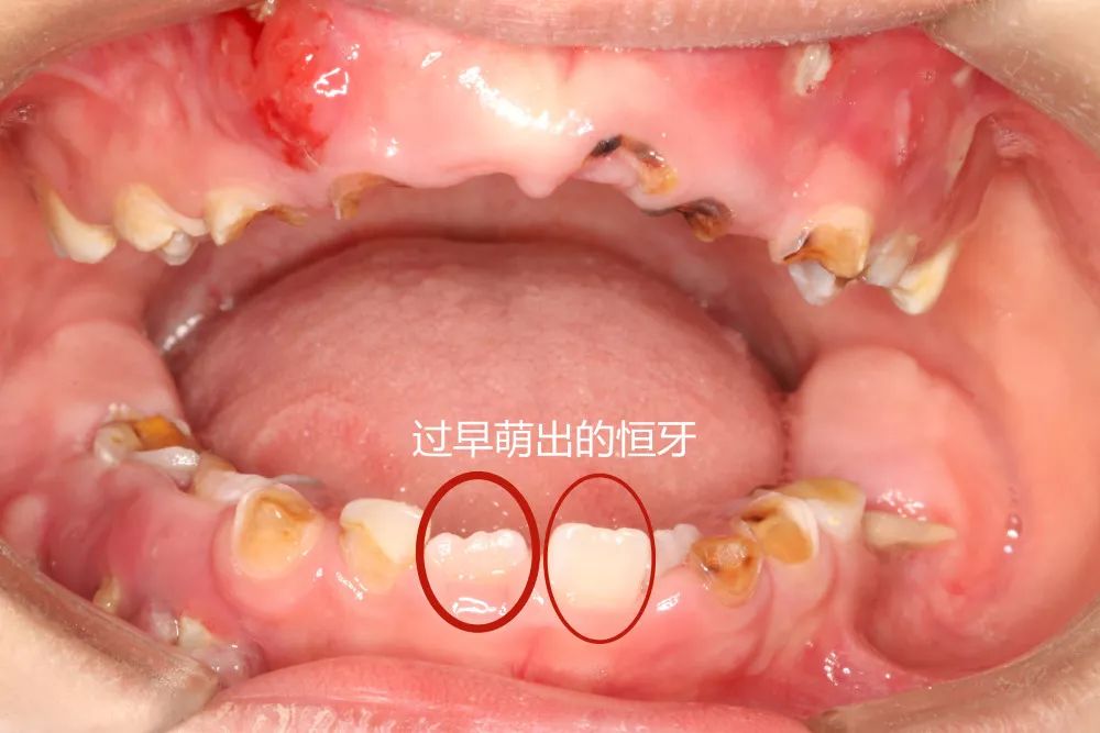 乳牙坏了不用管？未及时治疗，4岁男童一口牙几乎烂光