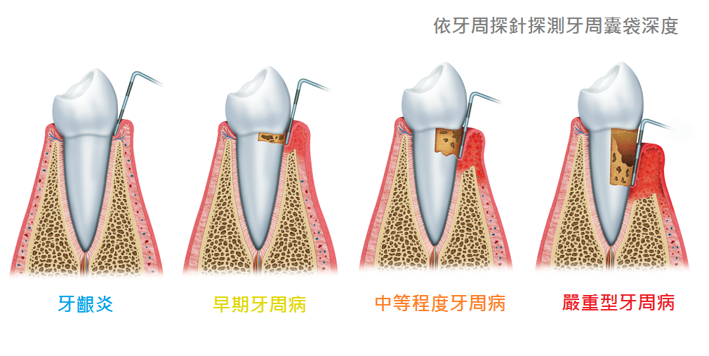 在珠海根管治疗后如果不做牙冠，你的牙齿会……