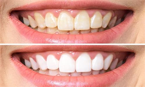 teeth-before-after-whitening_168410-587