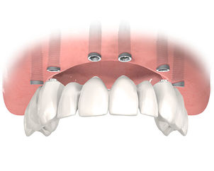 All-teeth-fixed-1_00a9ff7fe1bce3d6ba2e1f7