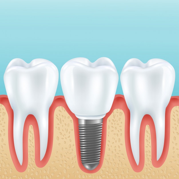 dental-prosthetics-with-healthy-teeth_1284-32619