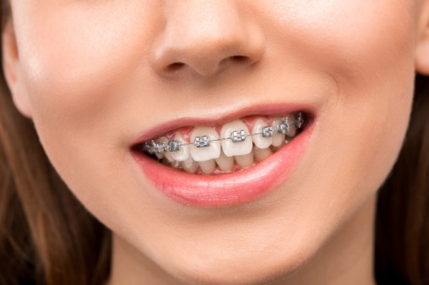 beautiful-young-woman-with-teeth-braces_155003-10309