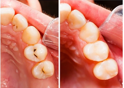 teeth-before-after-treatment-dental-260nw-140401018