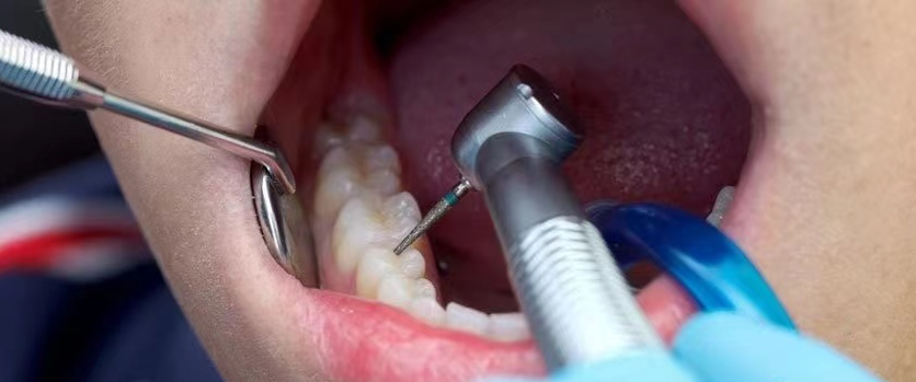 洗牙真的会导致牙缝变宽、牙齿鬆动吗？