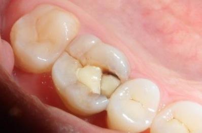 为什么乳牙蛀牙也要及时补？