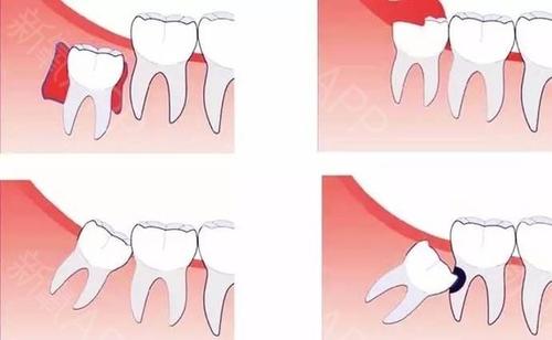 智齿必须拔除的三大理由