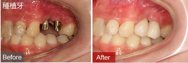 深圳範小姐種植牙和根尖囊腫切除案例