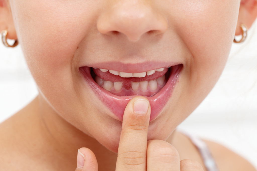 孩子牙齿里出外进、参差不齐，趁早去矫正，真的有必要吗？