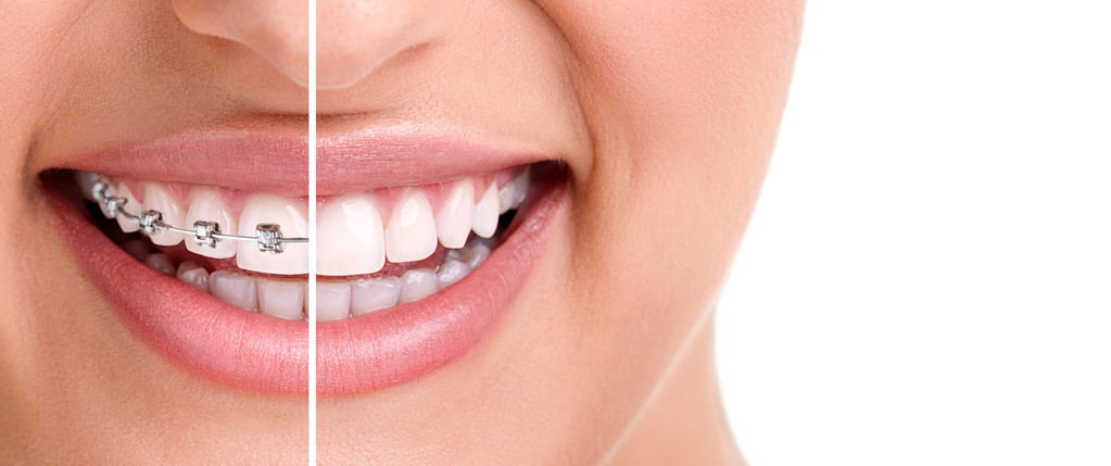 错过牙齿矫正黄金期，成年人还可以做牙齿矫正吗？