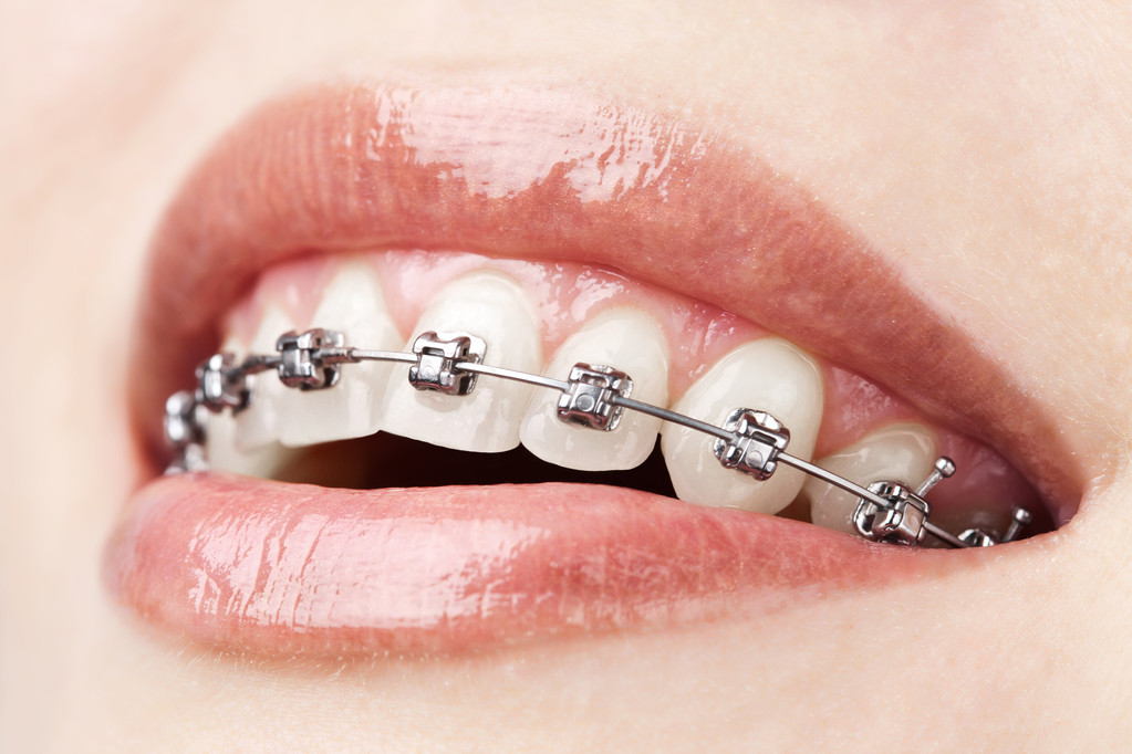 做牙齿矫正为何要经历洗牙洗牙、补牙、拔牙三部曲？