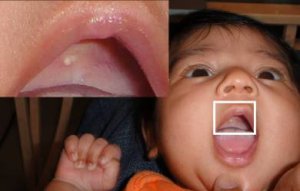 小宝宝嘴巴里的“小白点”，是长牙了吗?#叶子口腔科普#